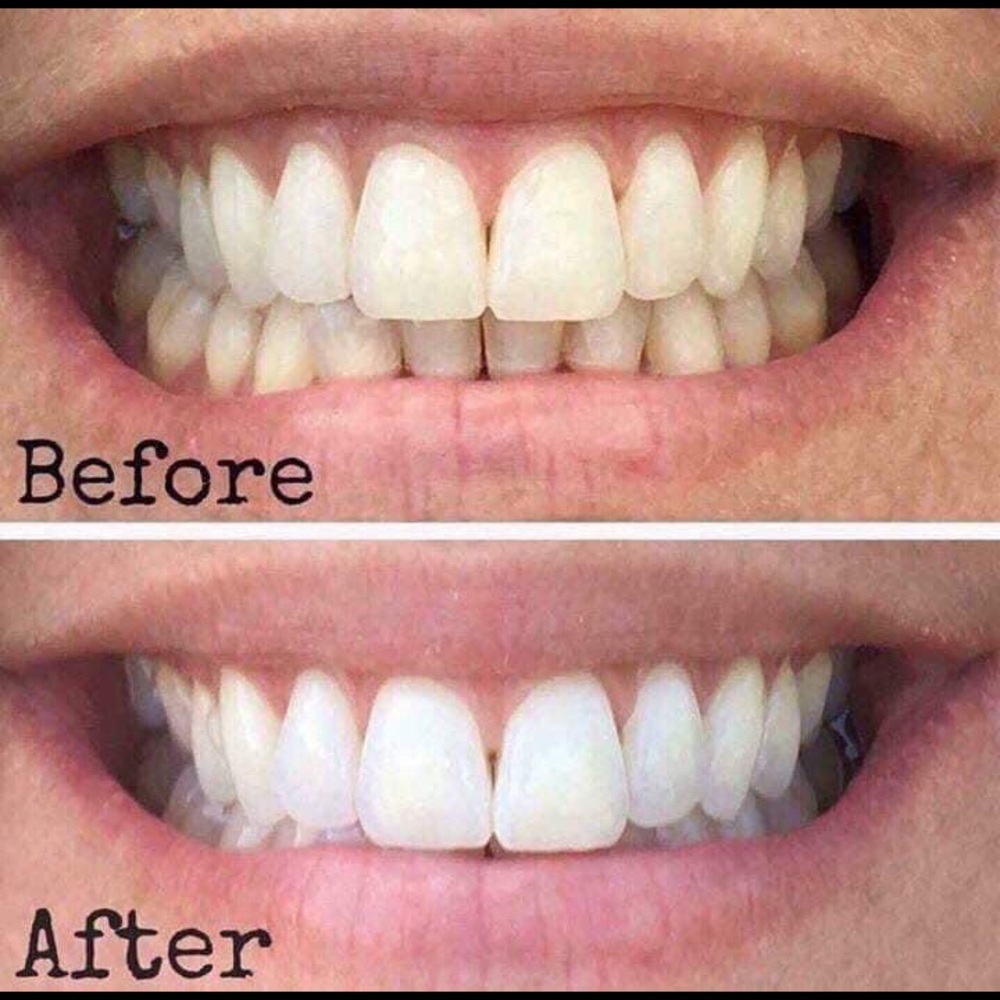Whitening Toothpaste